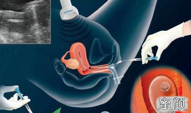 在这个地方预先选择借卵做试管婴儿的性别并不违法