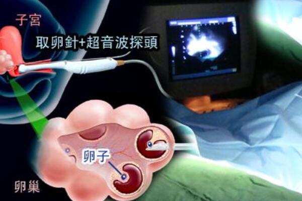 第二代借卵做三代供卵试管不成功与什么有关
