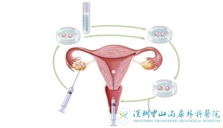 什么是精子分离术带你了解这项生育技术